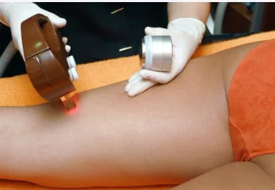 laser hair removal in Singapore